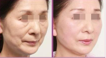 南京激光去皱可以维持多久?