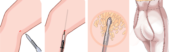 吸脂手术真的可以使小腿瘦下去吗?