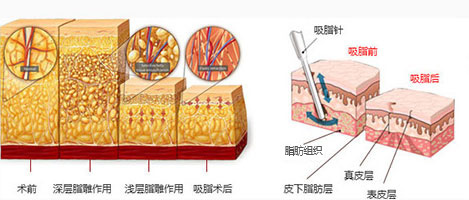 南京做臀部吸脂手术存在危害吗?