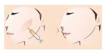 南京做面部填充过程?