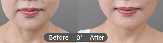 祛除面部皱纹的方法有哪些?