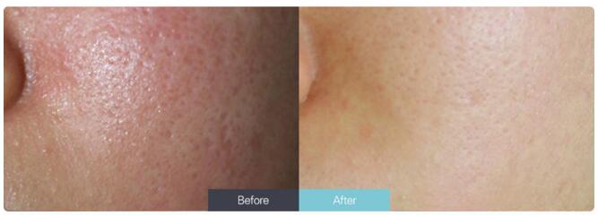 南京注射注射水光有什么效果?