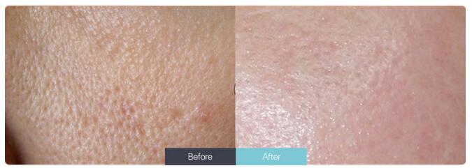 南京收缩毛孔的方法有哪些?